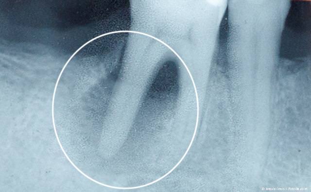 Wurzelbehandlung: Abgestorbener Zahn mit Entzündung im Kieferknochen