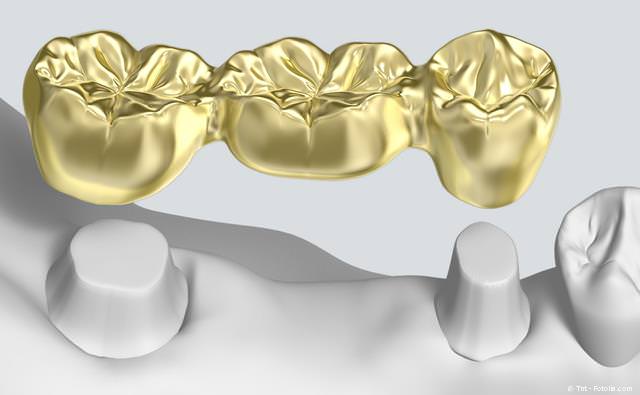 Implantat mit Krone statt Zahnbrücke