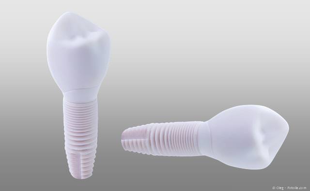 Keramik-Implantat: Wenn kein Metall im Mund möglich ist