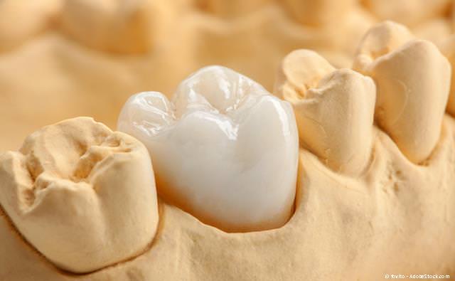 Zahnkronen -auch aus Keramik - zur Erhaltung von Zähnen
