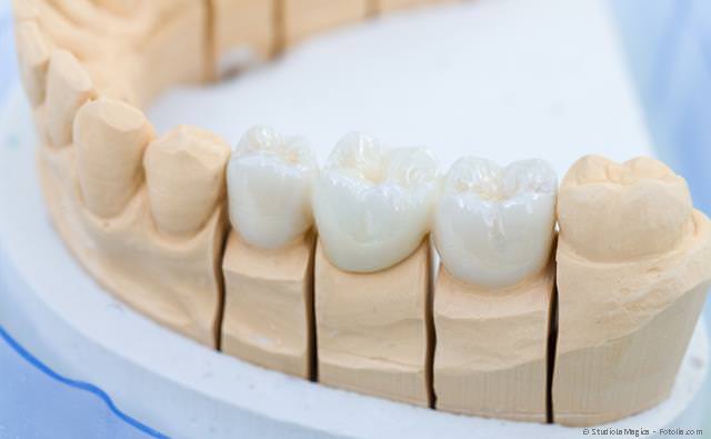 Zahnbrücken -auch aus Keramik - zum Schließen kleiner Zahnlücken