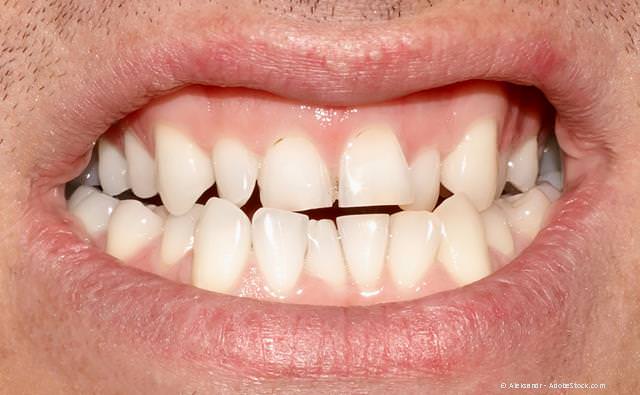Erwachsenen-Gebiss: Zu eng stehende Zähne und ein teilweiser Kreuzbiss (falscher Zusammenbiss der Zähne) können Probleme mit den Kiefergelenken verursachen.