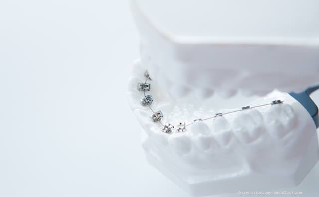 Zierliche, präzise anliegende Brackets auf der Innenseite der Zähne bei der Zahnregulierung mit Lingualtechnik