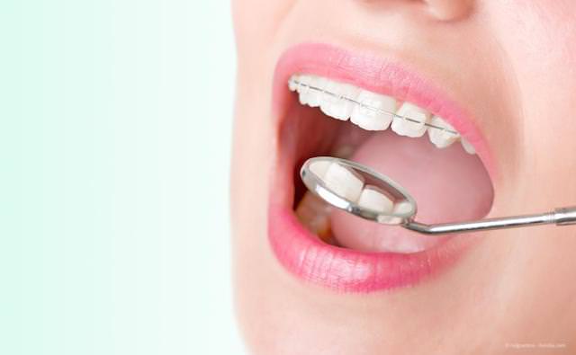 Keine Angst vor dem Zähneziehen: Schnellere und angenehmere Zahnregulierung mit modernen Zahnspangen